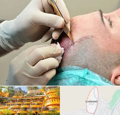 اسکالپ موی سر در دربند