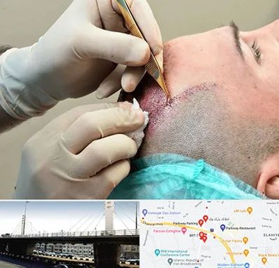 اسکالپ موی سر در پارک وی 