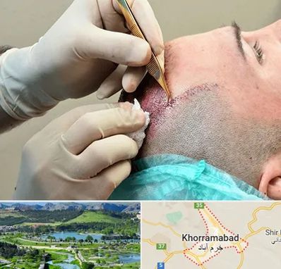 اسکالپ موی سر در خرم آباد