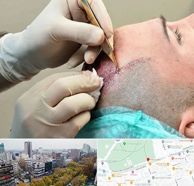 اسکالپ موی سر در بلوار کشاورز 