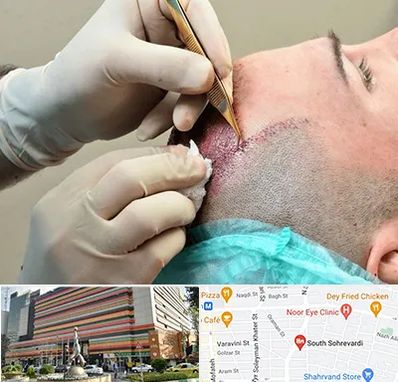 اسکالپ موی سر در سهروردی 