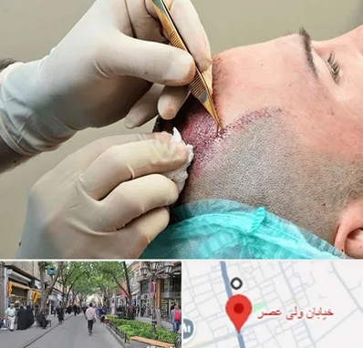 اسکالپ موی سر در ولیعصر شهریار