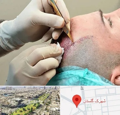 اسکالپ موی سر در شهرک گلستان