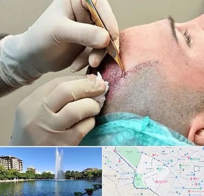 اسکالپ موی سر در کوهسنگی مشهد 