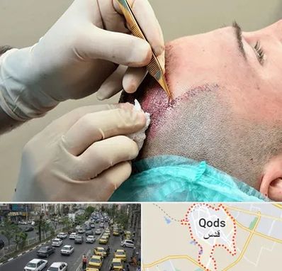 اسکالپ موی سر در شهر قدس