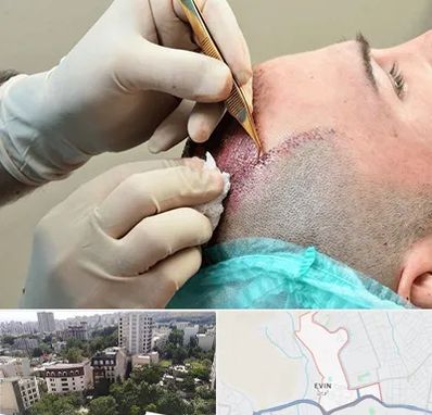 اسکالپ موی سر در اوین