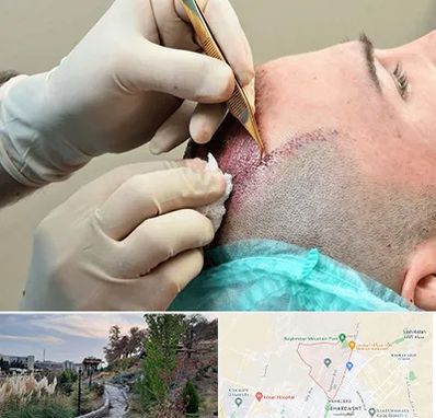 اسکالپ موی سر در باغستان کرج 