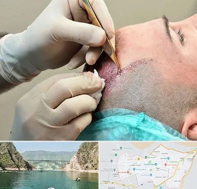 اسکالپ موی سر در ایلام