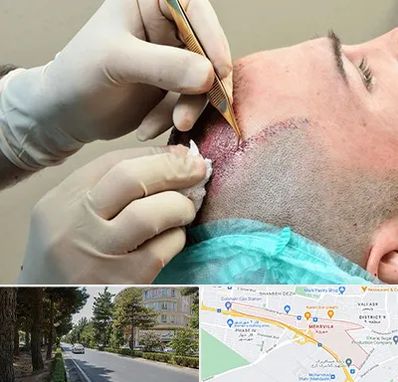 اسکالپ موی سر در مهرویلا کرج 