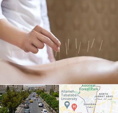 درای نیدلینگ در شهران 