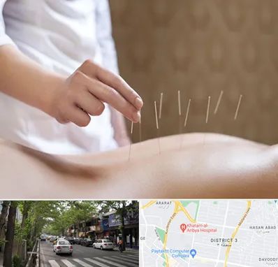 درای نیدلینگ در ظفر 