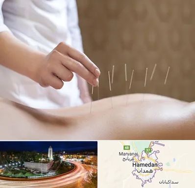 درای نیدلینگ در همدان