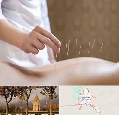 درای نیدلینگ در تویسرکان