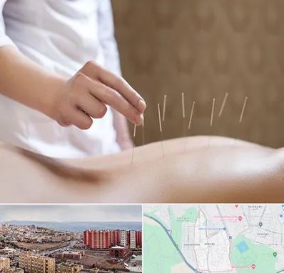 درای نیدلینگ در سهند تبریز