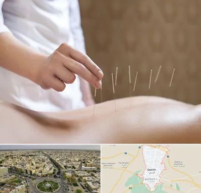 درای نیدلینگ در قزوین