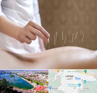 درای نیدلینگ در لاهیجان