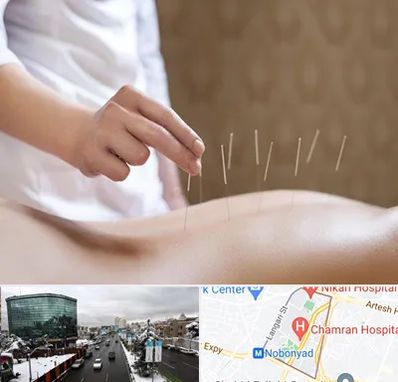 درای نیدلینگ در اقدسیه 