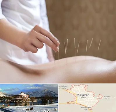 درای نیدلینگ در ملایر