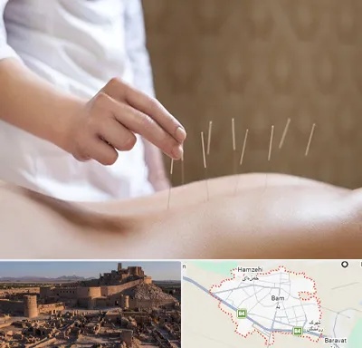 درای نیدلینگ در بم