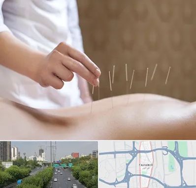 درای نیدلینگ در توانیر