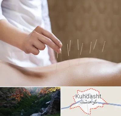 درای نیدلینگ در کوهدشت