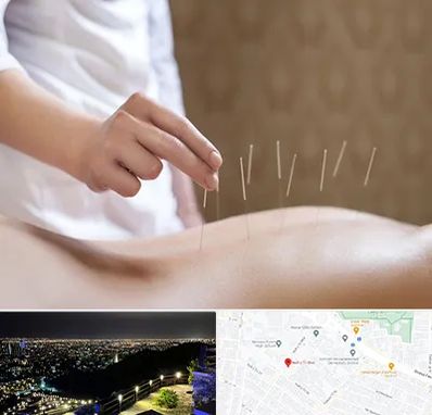 درای نیدلینگ در هفت تیر مشهد 