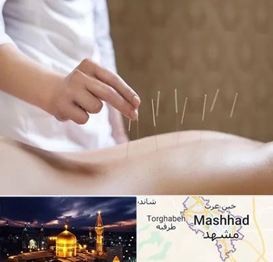 درای نیدلینگ در مشهد