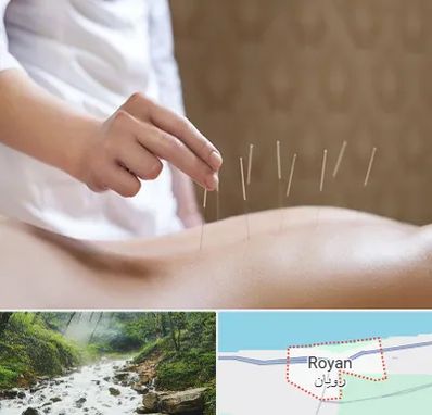 درای نیدلینگ در رویان