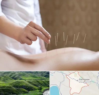 درای نیدلینگ در گچساران