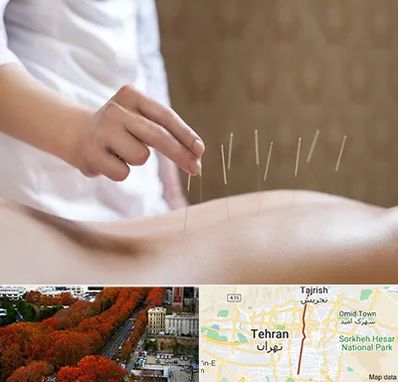 درای نیدلینگ در ولیعصر 