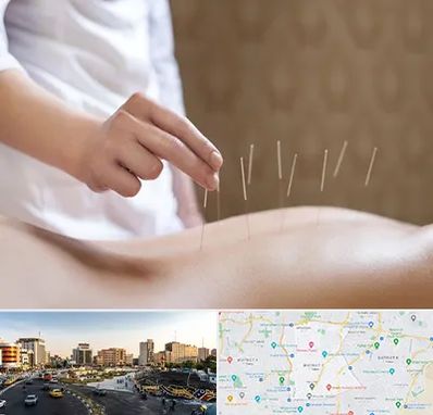 درای نیدلینگ در منطقه 7 تهران 