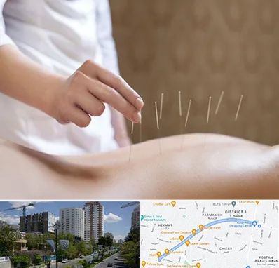 درای نیدلینگ در اندرزگو 