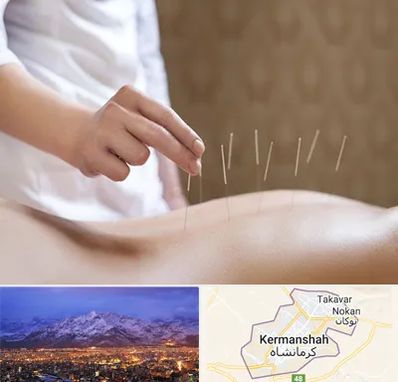 درای نیدلینگ در کرمانشاه