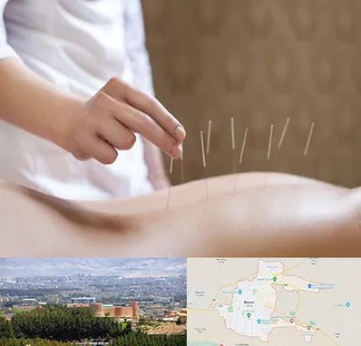 درای نیدلینگ در بیرجند