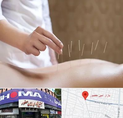 درای نیدلینگ در امین حضور