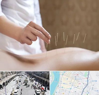 درای نیدلینگ در نادری اهواز 