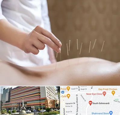 درای نیدلینگ در سهروردی 