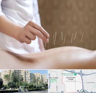 درای نیدلینگ در آپادانا