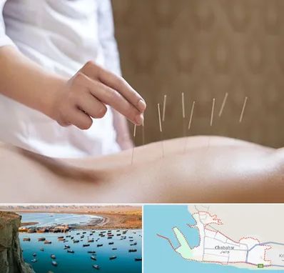 درای نیدلینگ در چابهار