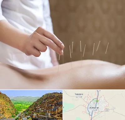 درای نیدلینگ در کامیاران