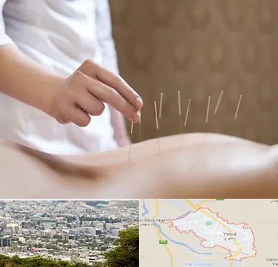 درای نیدلینگ در یاسوج