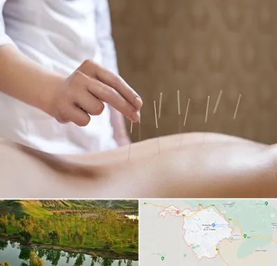 درای نیدلینگ در بهبهان