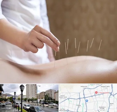 درای نیدلینگ در شمال غرب تهران
