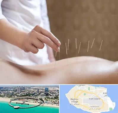 درای نیدلینگ در کیش