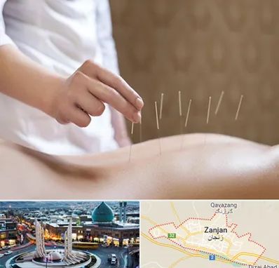 درای نیدلینگ در زنجان