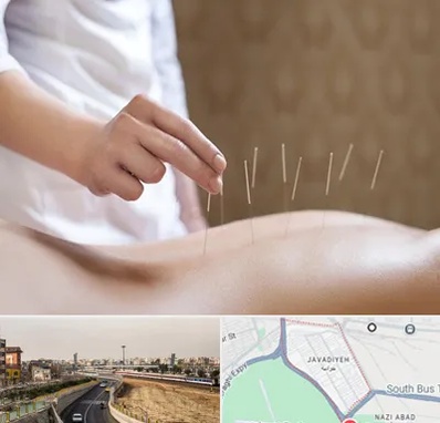 درای نیدلینگ در جوادیه