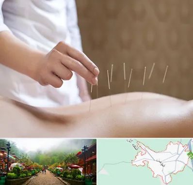 درای نیدلینگ در فومن