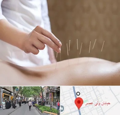 درای نیدلینگ در ولیعصر شهریار