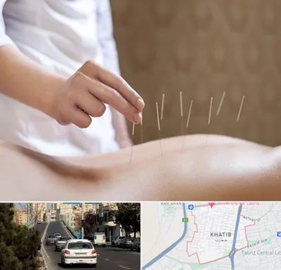 درای نیدلینگ در خطیب تبریز