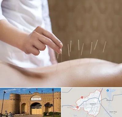 درای نیدلینگ در ایرانشهر